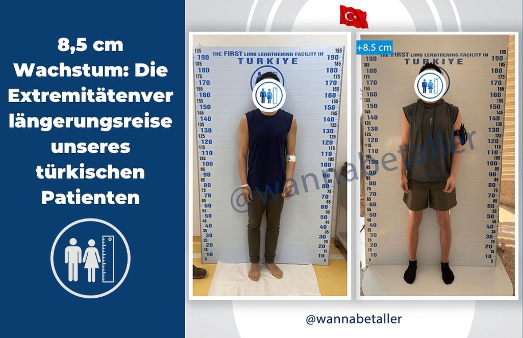 8,5 cm Wachstum: Die Extremitätenverlängerungsreise unseres türkischen Patienten